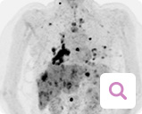 Diagnoseverfahren bei metastasiertem Brustkrebs: Positronenemissionstomographie (PET)