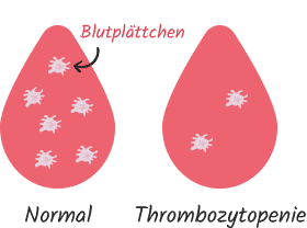 Thrombozytopenie - Reduktion der Blutplättchen