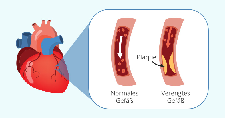 Entstehung der Angina pectoris