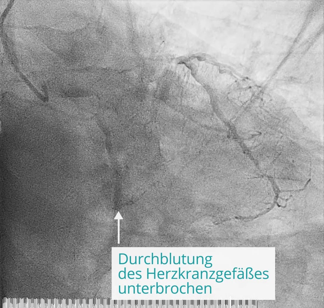 Koronar-Angiografie: Durchblutung unterbrochen