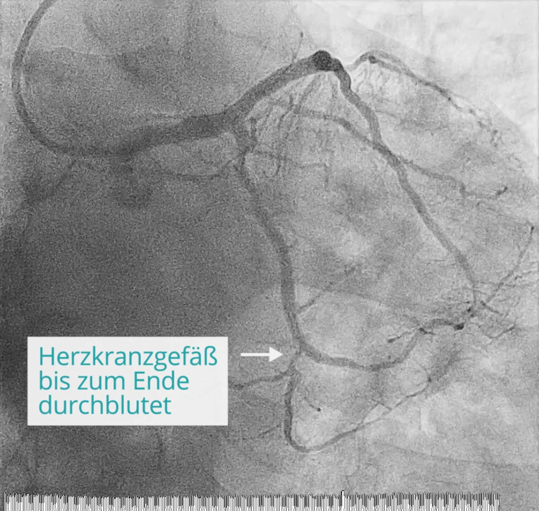 Koronar-Angiografie: Herzkranzgefäß durchblutet