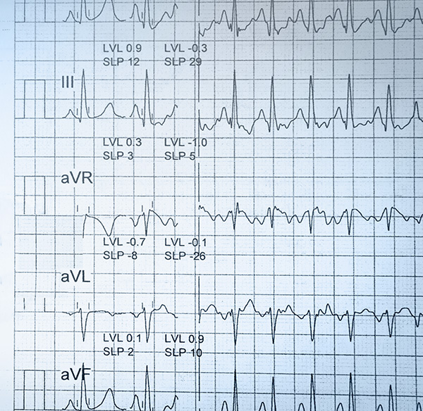 Diagnose der Angina pectoris: Untersuchungsmethode Elektrokardiogramm (EKG)