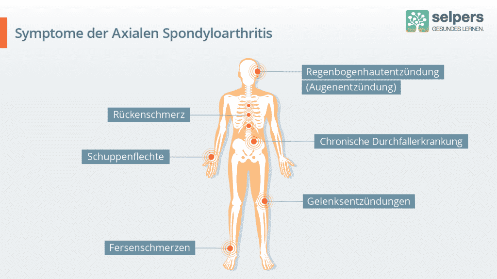 Symptome der axialen Spondyloarthritis