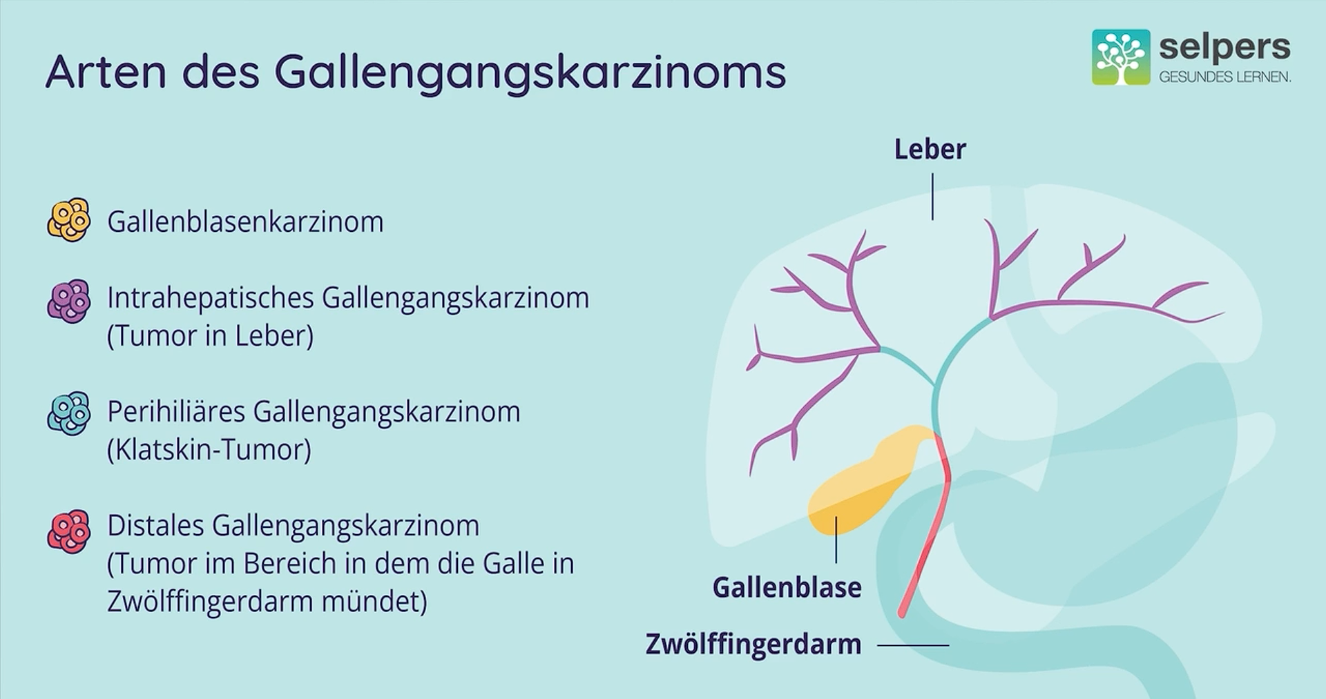 Gallengangskrebs verstehen verschiedene Arten des Karzinoms