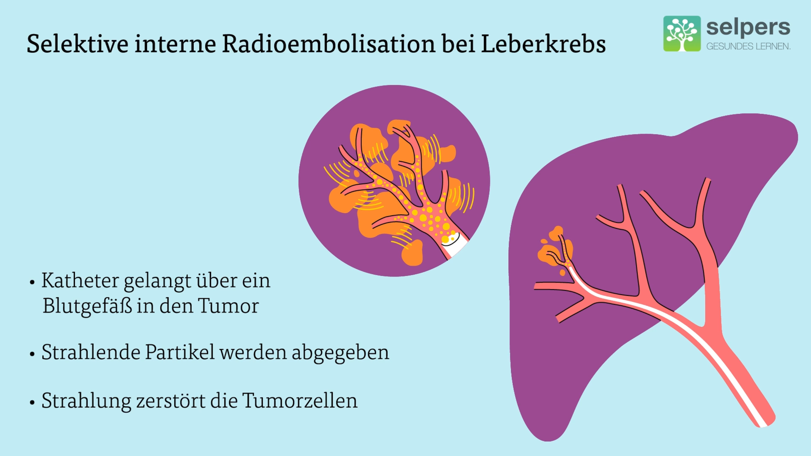 Behanldung von Leberkrebs Selektive interne Radioembolisation Strahlentherapie bei Leberkrebs
