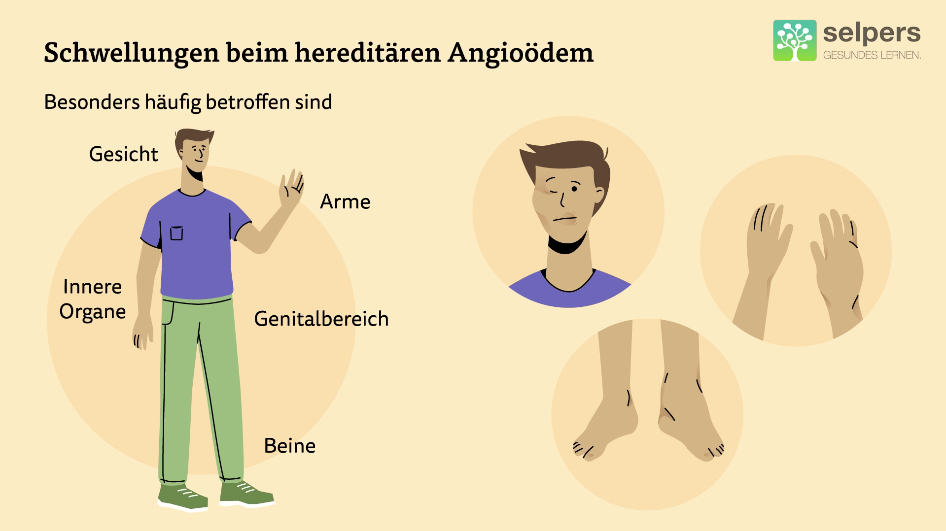 Bilder von Schwellungen beim hereditären Angioödem - Arme, Beine, inneren Organe und Genitalbereich