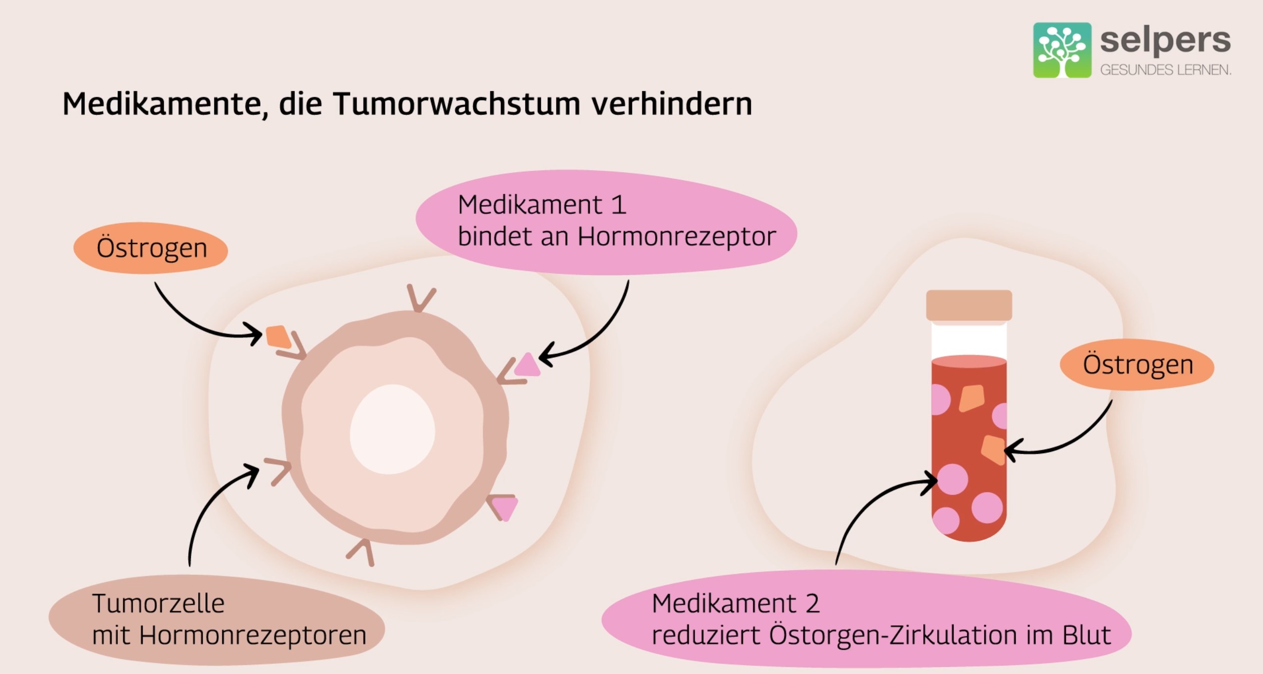 Therapieansätze bei hormonrezeptor-positivem Brustkrebs