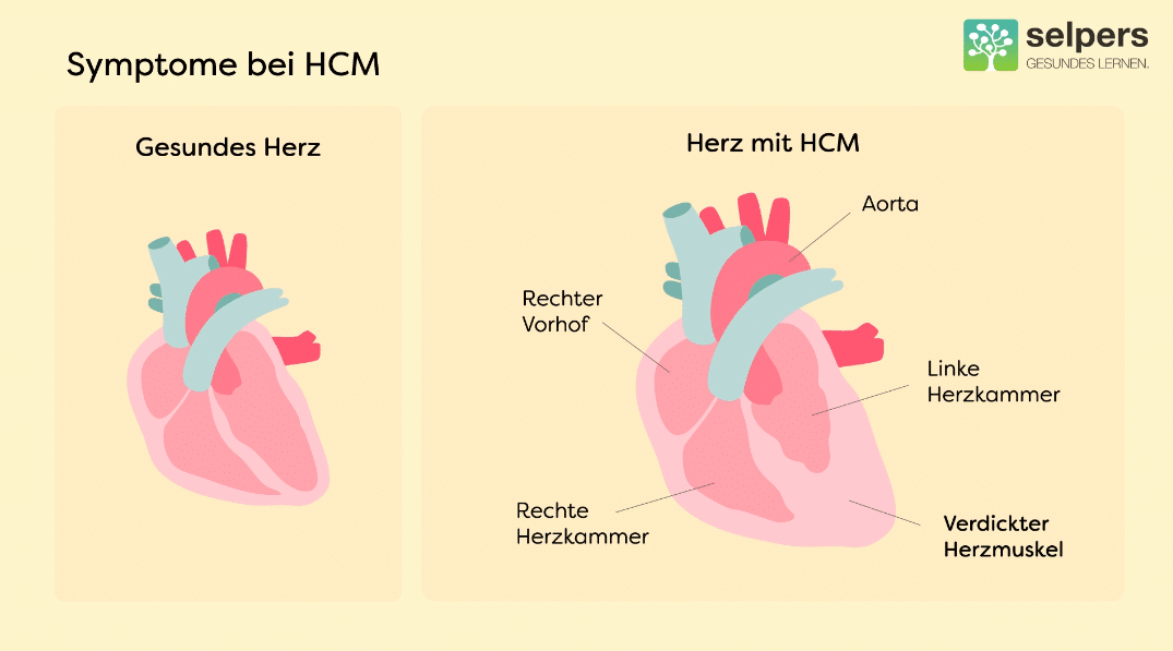 Symptome bei HCM: Vergleich gesundes Herz - Herz mit HCM. Herz mit HCM unterscheidet sich durch einen verdickten Herzmuskel.