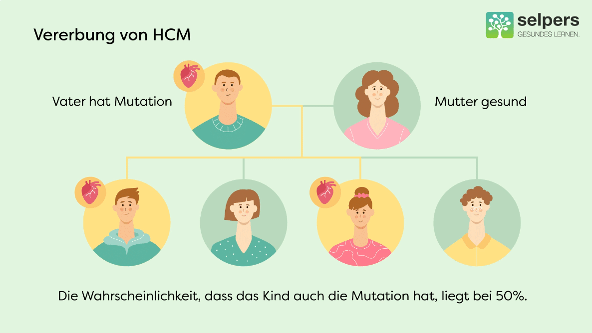 Die Abbildung zeigt, wie die Vererbung von HCM funktioniert. Hat der Vater die Mutation und die Mutter nicht, liegt die Wahrscheinlichkeit, dass das Kind auch die Mutation hat, bei 50 Prozent.